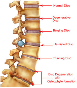 Spine with compression